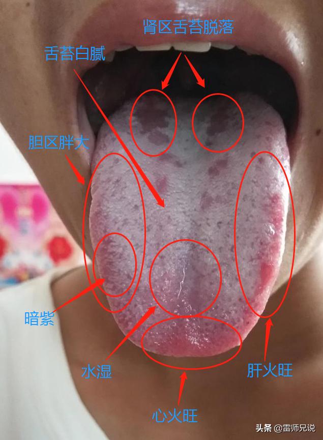 舌像分析 舌头大小:稍大,虚证 舌根部舌苔剥落:肾虚的表现,舌苔剥落