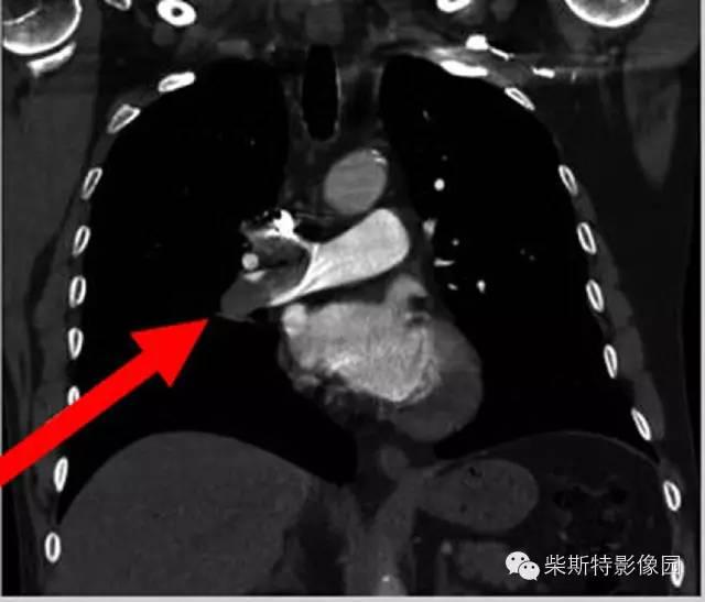 肺栓塞怎么检查，怎么样检查才可以查出肺栓塞（其实 7 个检查就搞定）