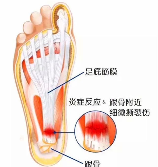 足底疼痛位置图，脚底疼痛部位图解（足跟痛是什么？要怎样预防）