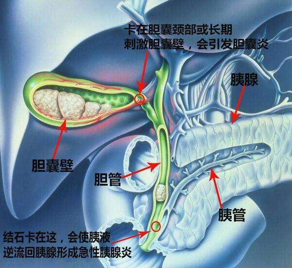 胆囊结石严重吗?多大需要治疗?看完这篇文章你就清楚了