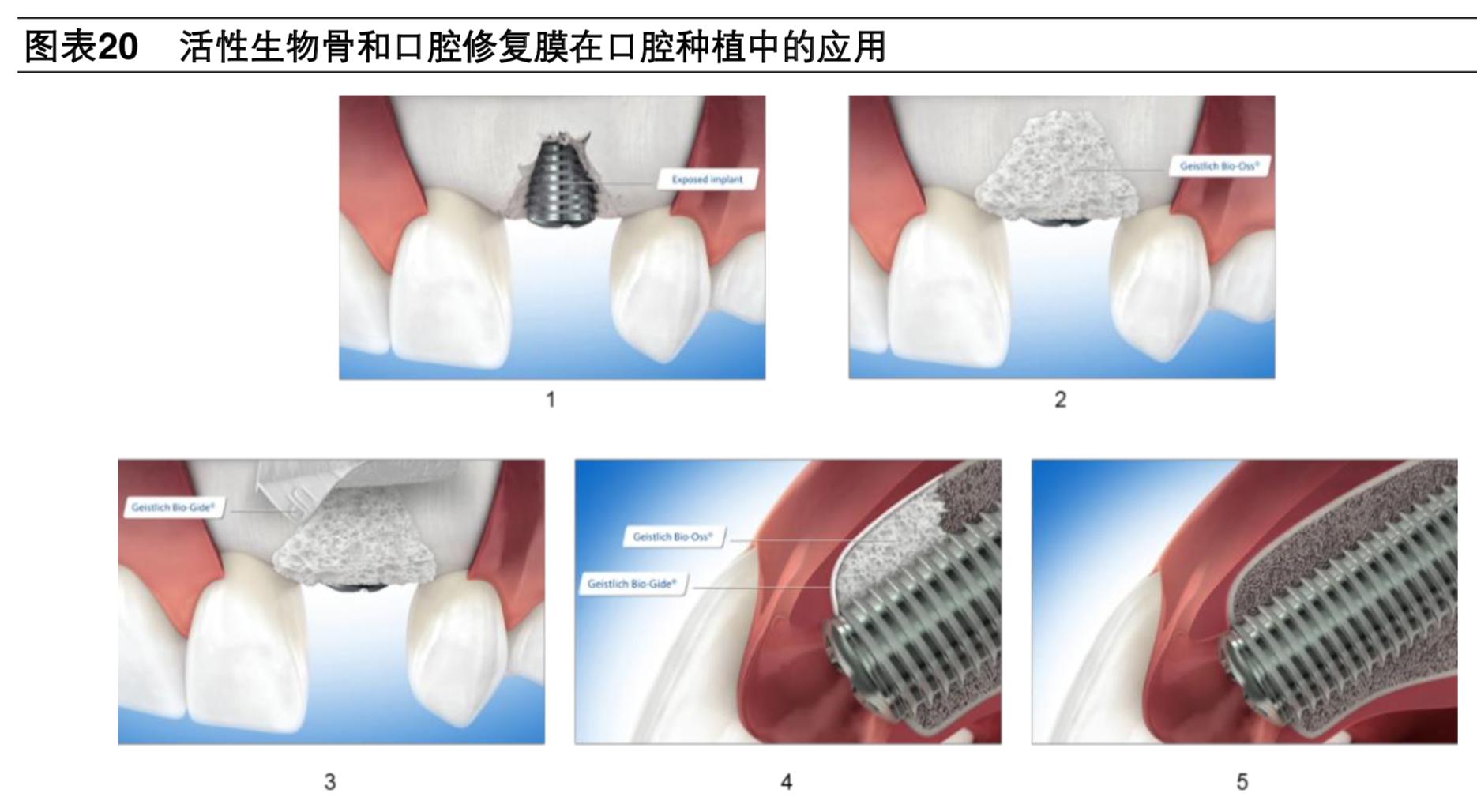 牙科医疗专题报告：种植牙深度研究