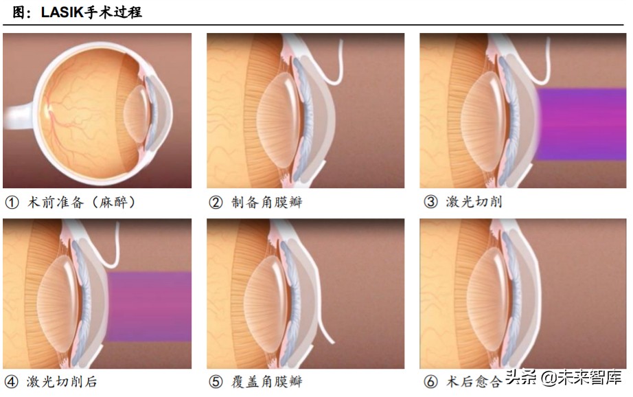眼科產業鏈深度報告：創新驅動，服務為王