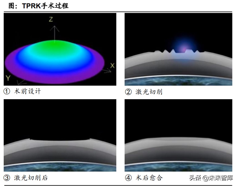 眼科產業鏈深度報告：創新驅動，服務為王