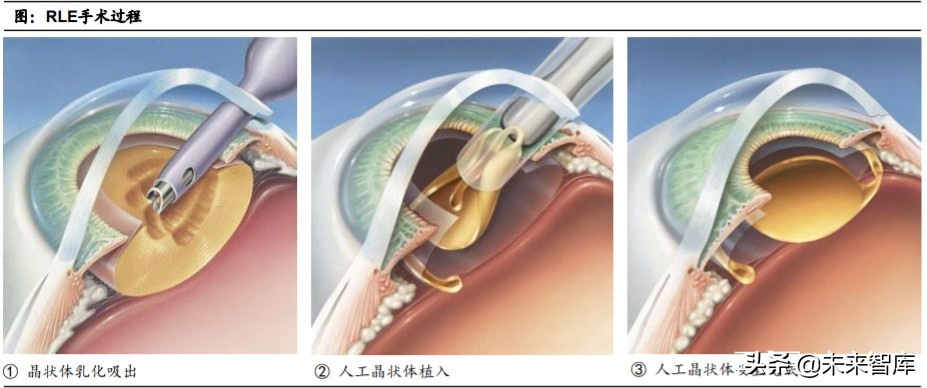 眼科產業鏈深度報告：創新驅動，服務為王