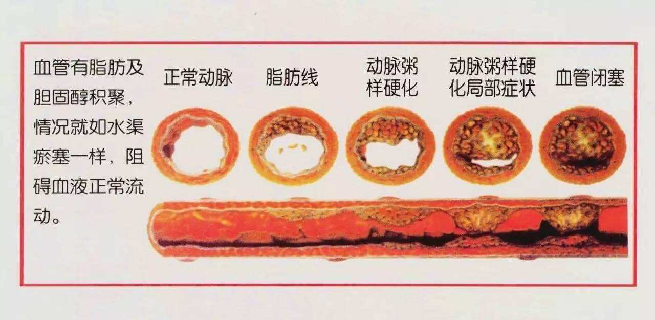 主动脉硬化是怎么回事60岁的赵阿姨主动脉硬化