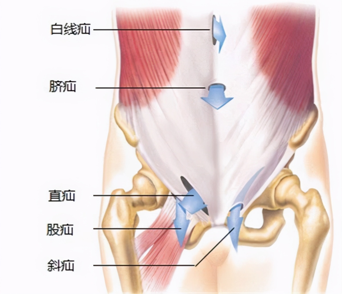 小孩疝气腹股沟疝在什么位置_有问必答_快速问医生