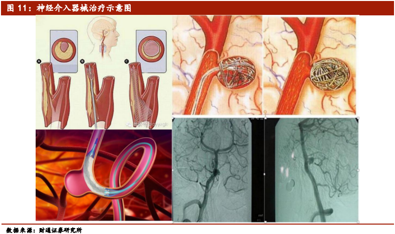 医疗介入器械行业深度报告