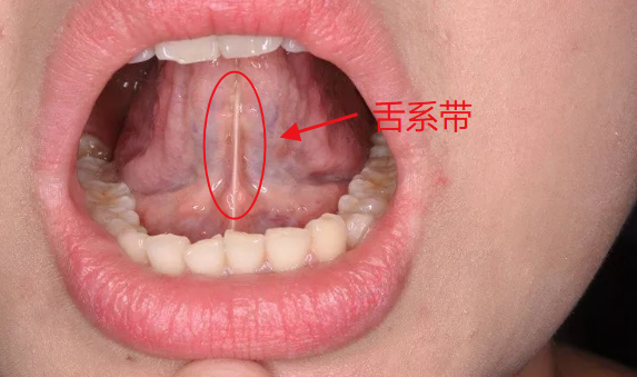 剪舌系带多少钱舌头形状不对