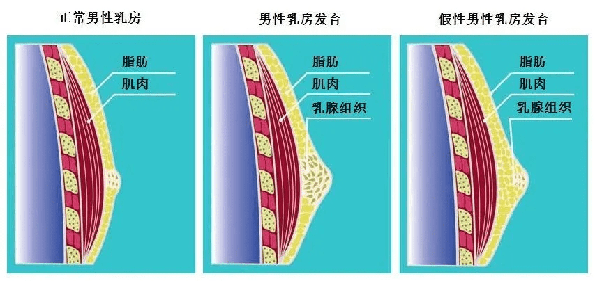 我大学这胸算正常吗青春期男孩乳房发育直径长达4cm