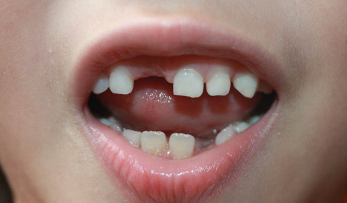 梦见自己牙掉了怎么样(梦见自己掉牙齿了,会是什么意思?