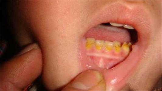 氟斑牙:由于长期饮用富含氟的水,超过安全量,导致牙齿发黄