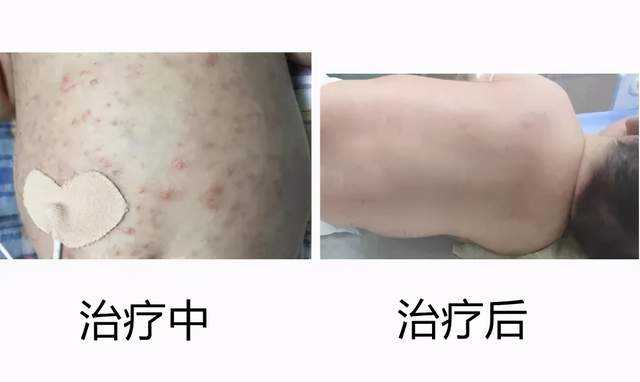 湘潭县妇幼保健院新生儿科助新生宝宝成功战“痘”