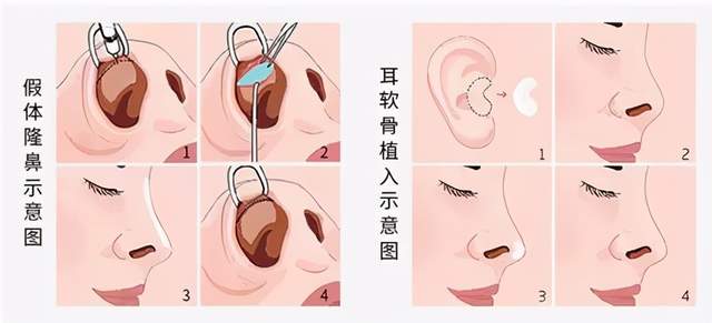 同样是自体软骨,耳软骨与肋软骨各有哪些优缺点_隆鼻_隆鼻治疗介绍 - 