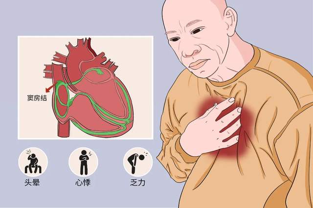 病态窦房结综合征简称病窦综合征,是由窦房结病变导致功能减退,产生多