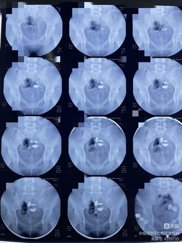 医生建议先做子宫输卵管造影检查进行排查