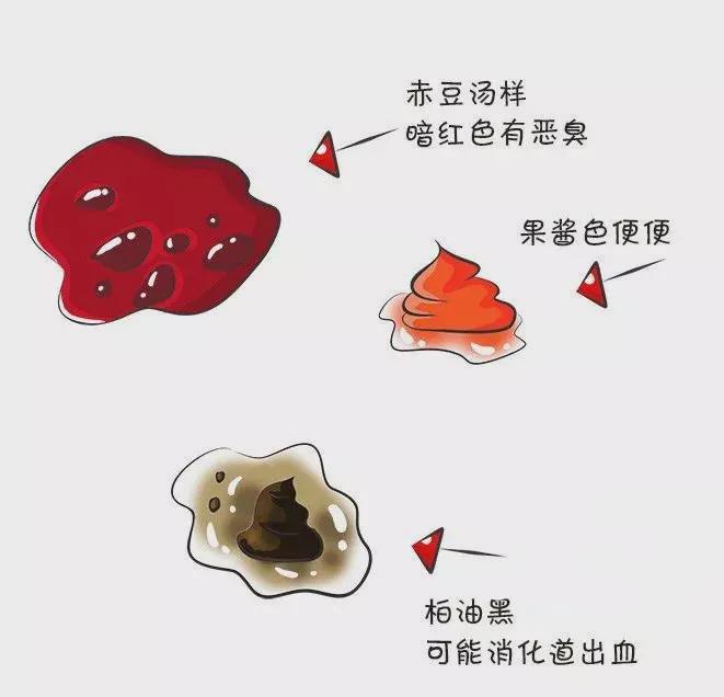 痔疮治疗新进展：从传统到现代的转变