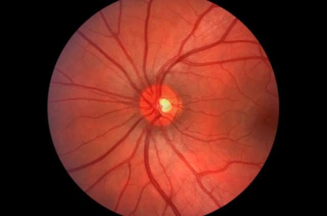 什么是眼底新生血管它是正常的血管吗