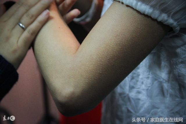 身体上的鸡皮疙瘩怎么治