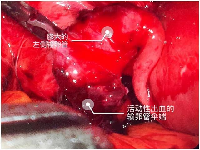 双胞胎隔“宫”相望，医生“攘外安内”