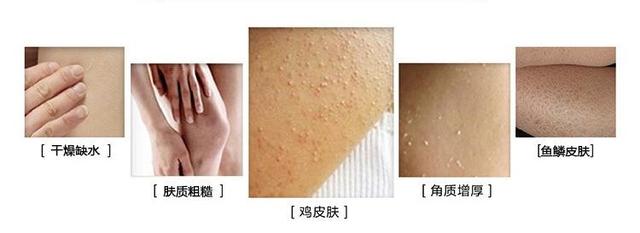 皮肤粗糙有鸡皮疙瘩痒吃什么药