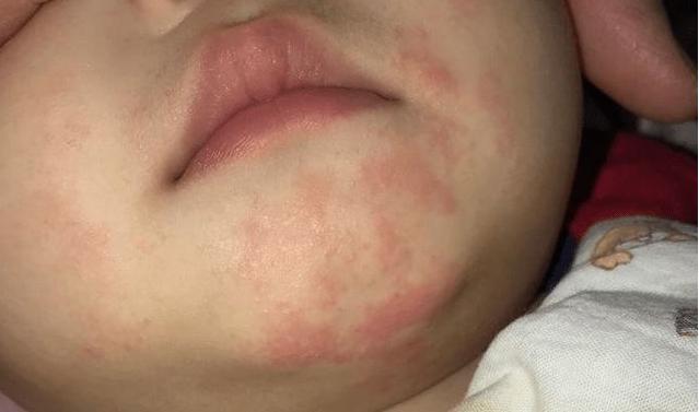 「婴儿护肤」万能炉甘石走下神坛？儿科药师：这情况不！能！用