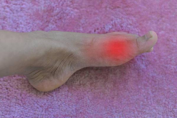 患上痛风时，脚部会有4种表现，若你有，要及时降尿酸了