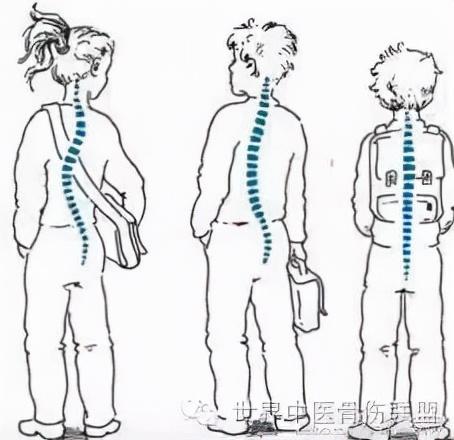 青少年预防颈椎病的四个要点