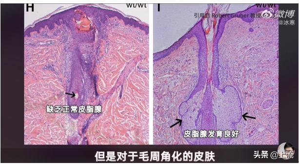汗毛长不出来成了鸡皮肤