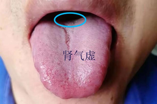 舌头有裂纹就是阴虚吗？教你形象地认识四种裂纹舌，十种舌象