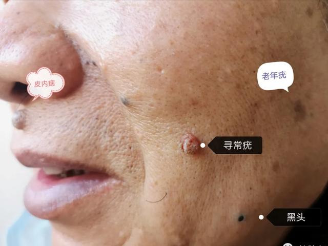 肥厚性日光性角化症