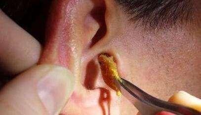 婴儿耳朵上长鸡皮疙瘩一样的