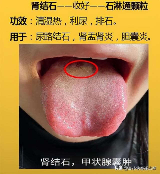 咽炎、高脂血症，四肢麻木，10个中成药，年过35岁后要收藏备好