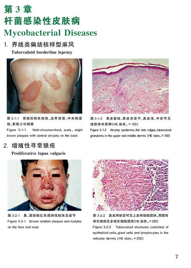肢端角化弹力纤维鉴别