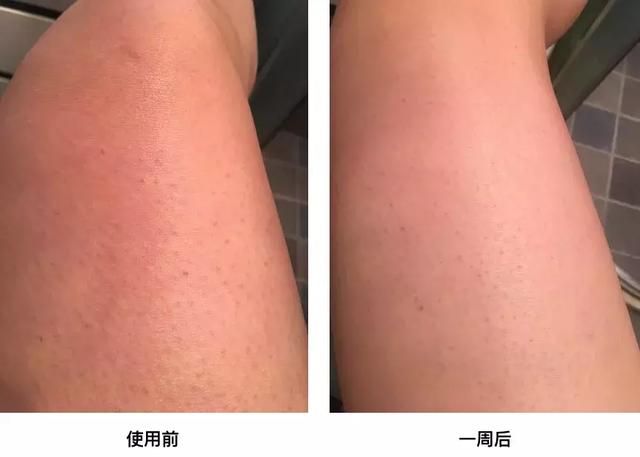 去鸡皮肤磨砂膏鸡皮疙瘩
