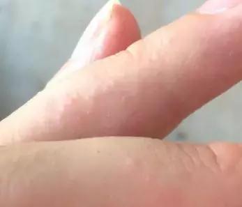 皮肤起了一层鸡皮疙瘩还很痒