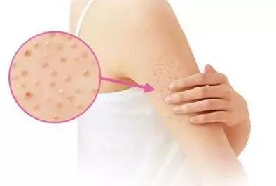 湿疹和鸡皮疙瘩痒