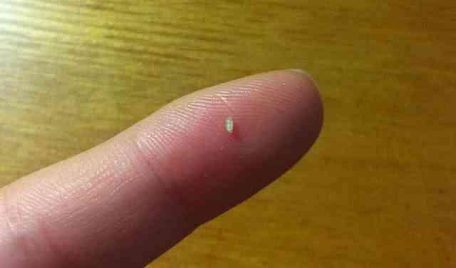 一颗被挤掉的油脂粒,鼻子油脂粒挤完有个洞-唯诗兰去脂肪粒