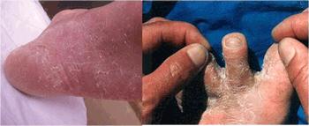 角化型湿疹口服点什么药