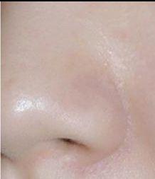 脸颊毛细血管扩张和毛周角化