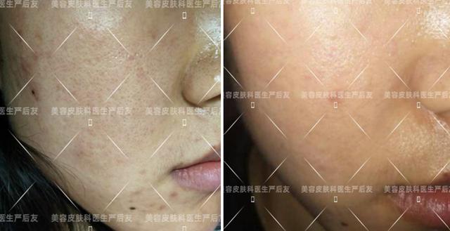 脸颊毛细血管扩张和毛周角化