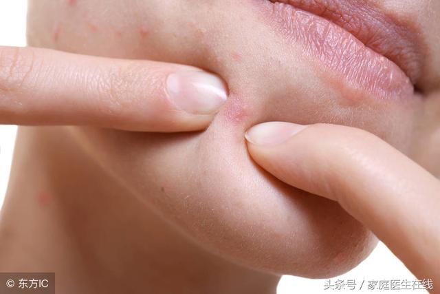 脸上总长粉刺怎么办