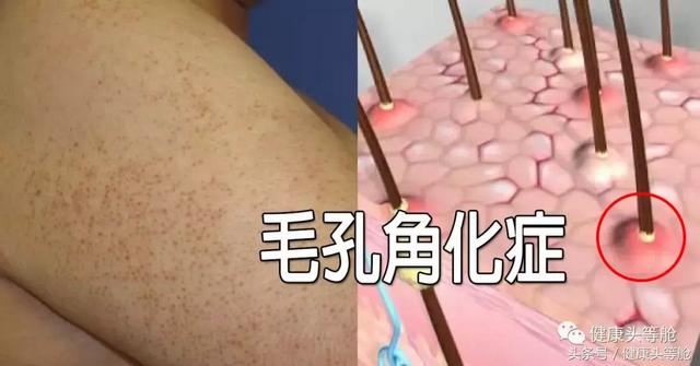 正角化明显不全角化