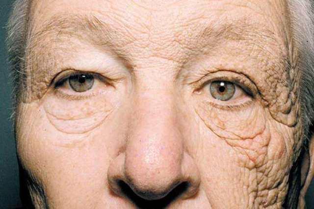 萎缩性日光角化病