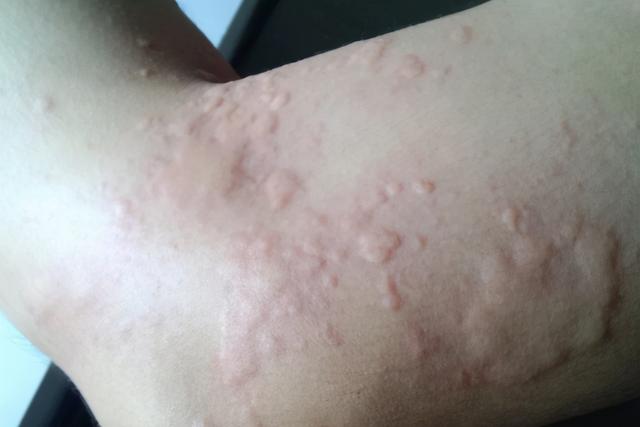 咬人的蚊子咬人的文字是公蚊子还是母蚊子