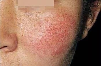 红血丝怎么去除最有效（去脸部红血丝的方法）