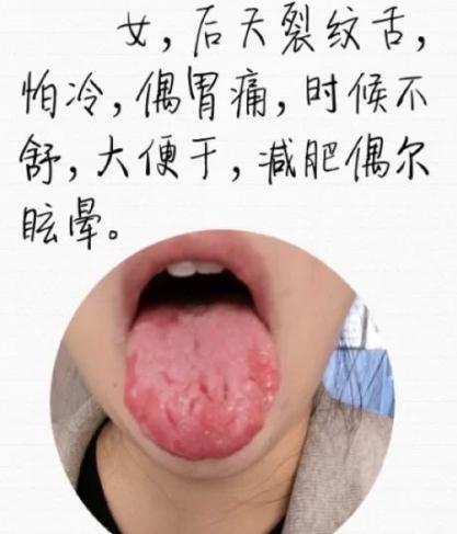 舌头有裂纹是怎么回事（常见的裂纹舌辩证）