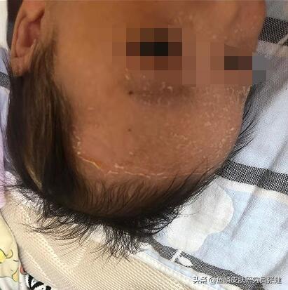 鱼鳞病选择什么时候怀孕比较