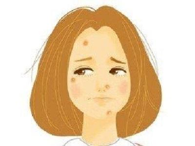 脂溢性角化硫磺皂