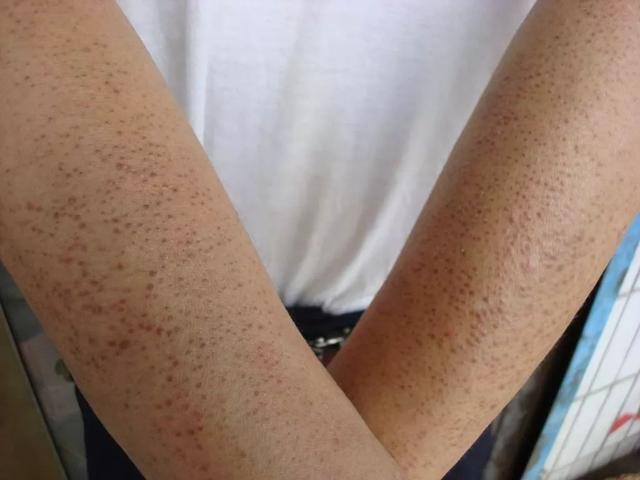 腋下皮肤有点像鸡皮疙瘩