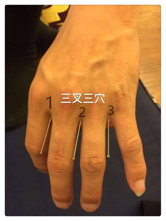 中医针灸上肢疾病处方6